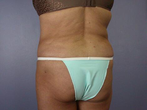 Liposuction Before & After Image