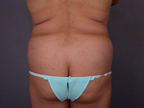 Liposuction Before & After Image