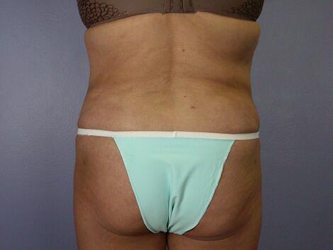 Liposuction Before & After Image