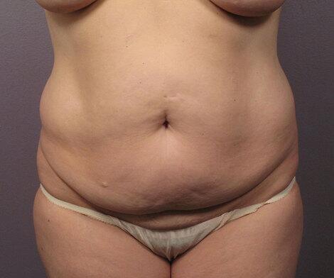 Liposuction Before & After Image