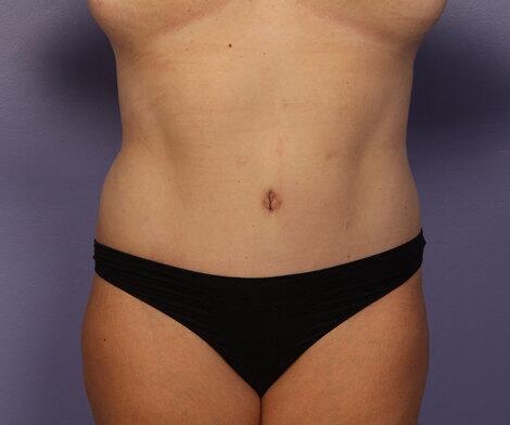 Liposuction Before & After Image