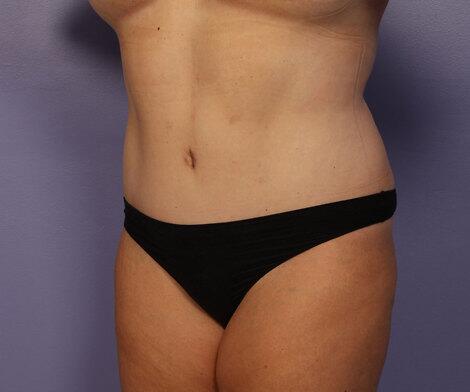 Liposuction Before & After Image