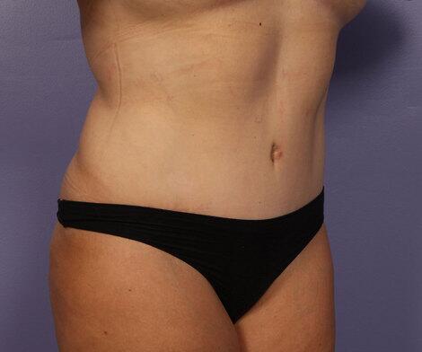 Liposuction Before & After Image