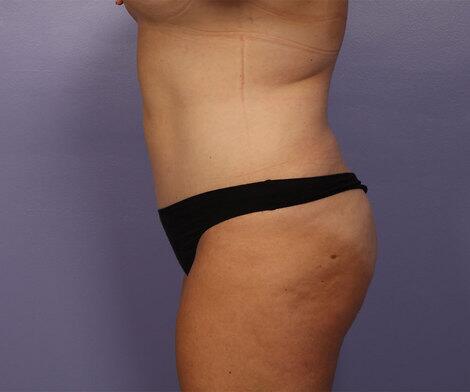 Liposuction Before & After Image