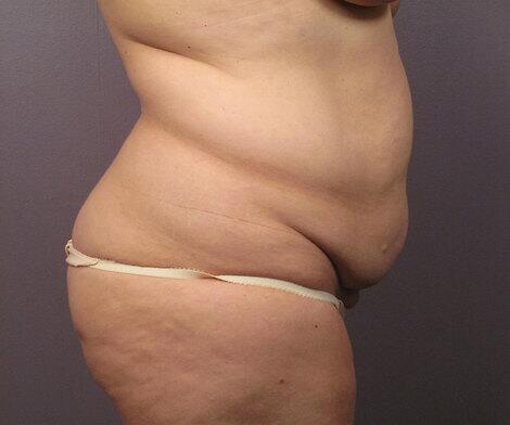 Liposuction Before & After Image