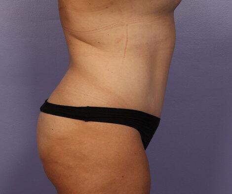 Liposuction Before & After Image