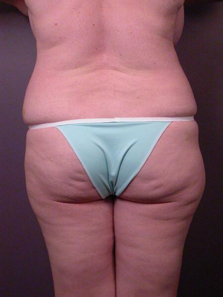 Liposuction Before & After Image