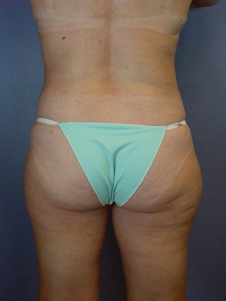 Liposuction Before & After Image