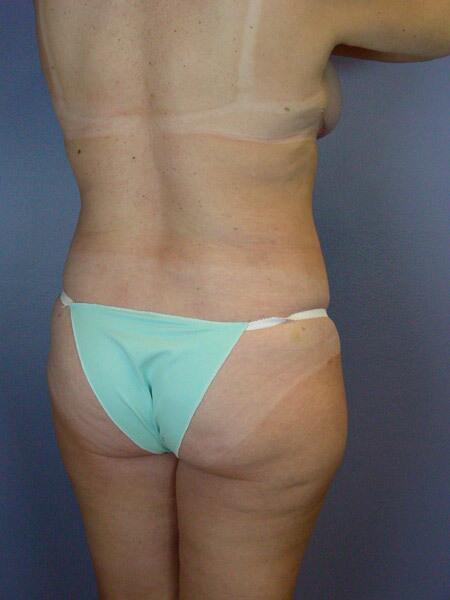 Liposuction Before & After Image