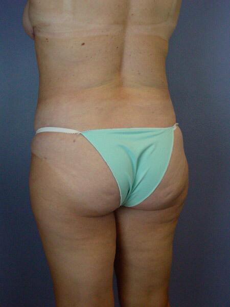 Liposuction Before & After Image