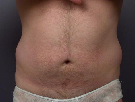 Liposuction Before & After Image