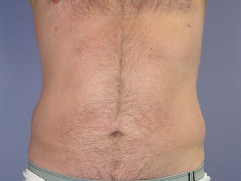 Liposuction Before & After Image