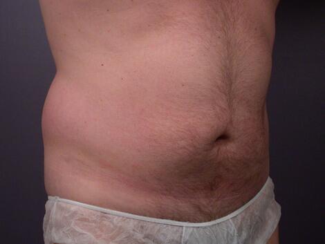 Liposuction Before & After Image