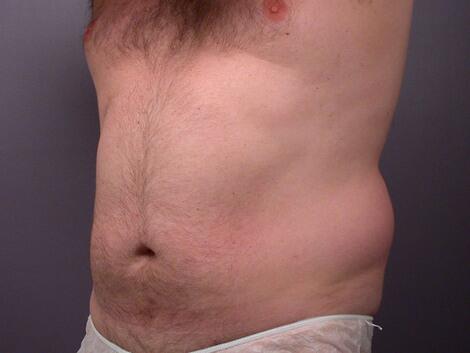 Liposuction Before & After Image