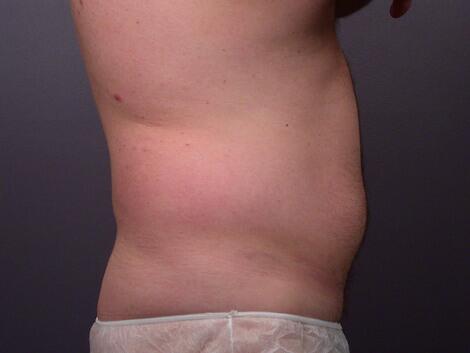 Liposuction Before & After Image