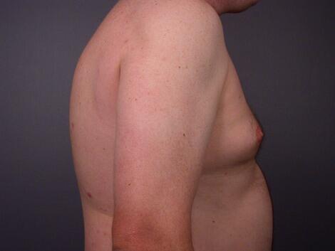 Liposuction Before & After Image