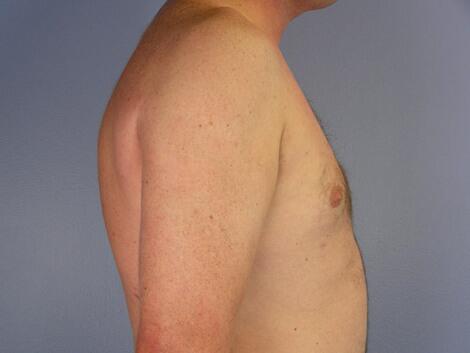 Liposuction Before & After Image