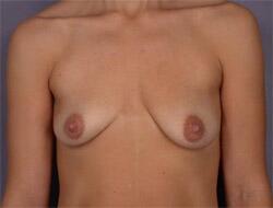 Liposuction Before & After Image