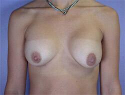 Liposuction Before & After Image