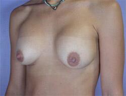 Liposuction Before & After Image