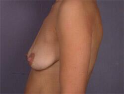 Liposuction Before & After Image