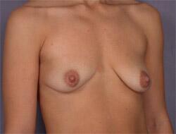 Liposuction Before & After Image