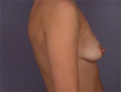 Liposuction Before & After Image