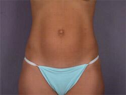 Liposuction Before & After Image