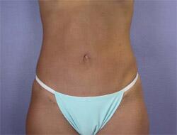 Liposuction Before & After Image