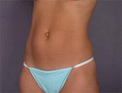 Liposuction Before & After Image