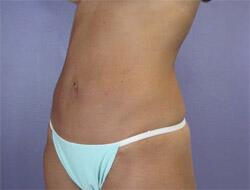 Liposuction Before & After Image