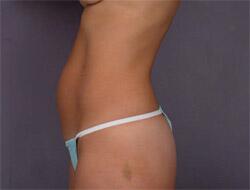 Liposuction Before & After Image