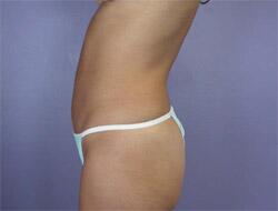 Liposuction Before & After Image