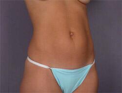 Liposuction Before & After Image