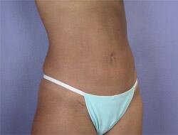 Liposuction Before & After Image