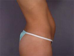 Liposuction Before & After Image