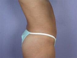 Liposuction Before & After Image