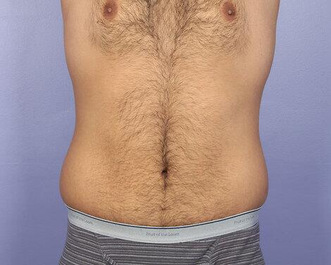 Liposuction Before & After Image