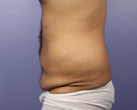 Liposuction Before & After Image