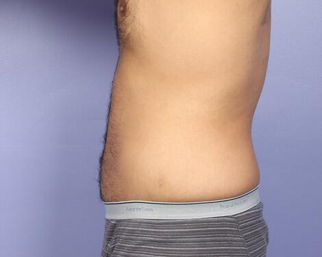 Liposuction Before & After Image