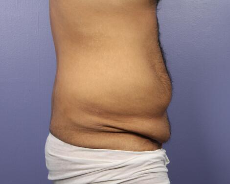 Liposuction Before & After Image