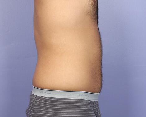 Liposuction Before & After Image