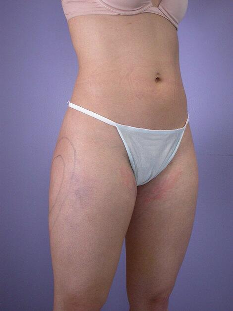 Liposuction Before & After Image