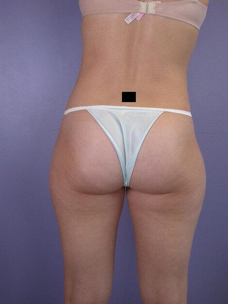 Liposuction Before & After Image