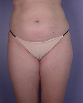 Liposuction Before & After Image