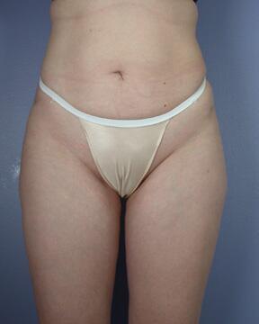 Liposuction Before & After Image