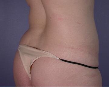 Liposuction Before & After Image