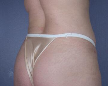 Liposuction Before & After Image