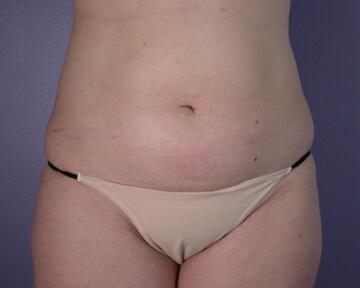 Liposuction Before & After Image