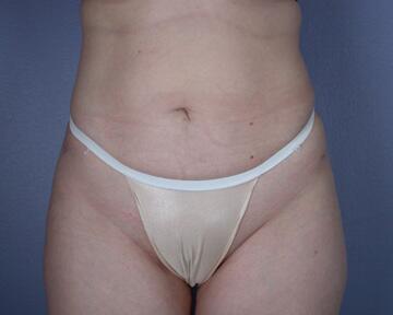 Liposuction Before & After Image